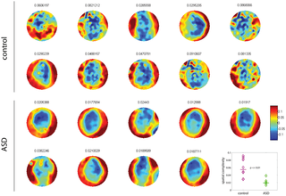 magnetoencefalografia  autismo precisione diagnosi ricerca