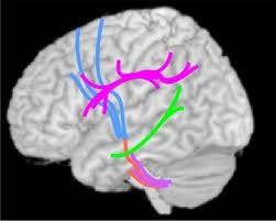 specificità strutturali cervello autismo